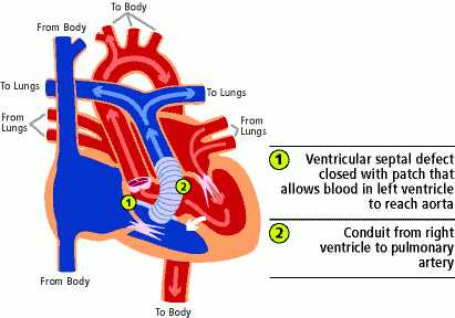Transposition of the great arteries