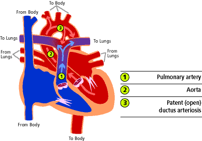 patent ductus arteriosus cs mott childrens hospital michigan patent ductus arteriosus