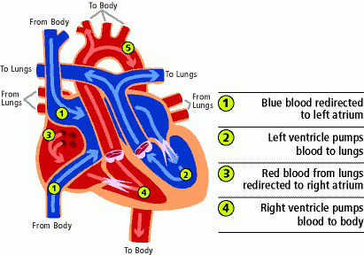 transposition of the great arteries