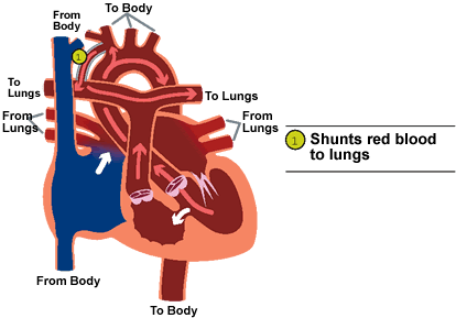tricuspid atresia